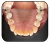 Upper Silicone Contrastor (190777 & 190778) Contrastor - Blue & Green Inc.