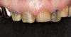 Palatal Silicone Contrastor, Children (190782) Contrastor - Blue & Green Inc.