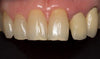 Palatal Silicone Contrastor, Children (190782) Contrastor - Blue & Green Inc.