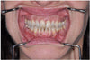 Metal Double Cheek Retractors (072753 / 072754) Retractors - Blue & Green Inc.
